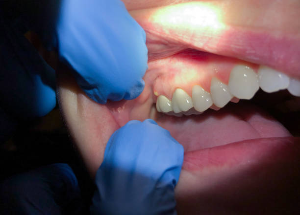 Best Emergency Dental Care for Broken or Chipped Teeth in Sackets Harbor, NY