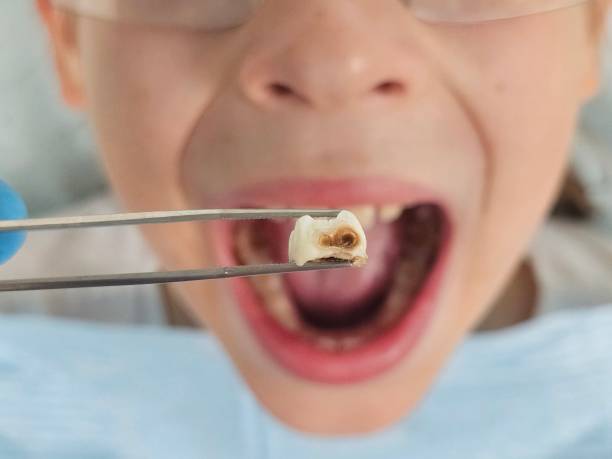 Best Emergency Wisdom Teeth Removal in Sackets Harbor, NY
